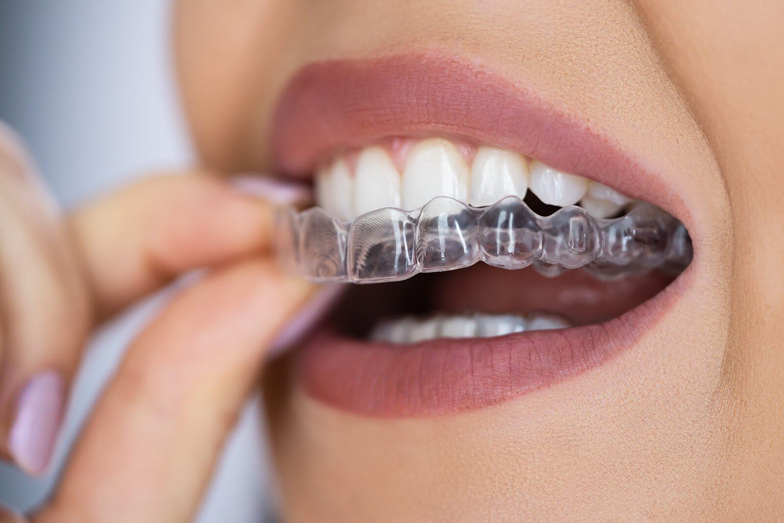 What Are Aligners?