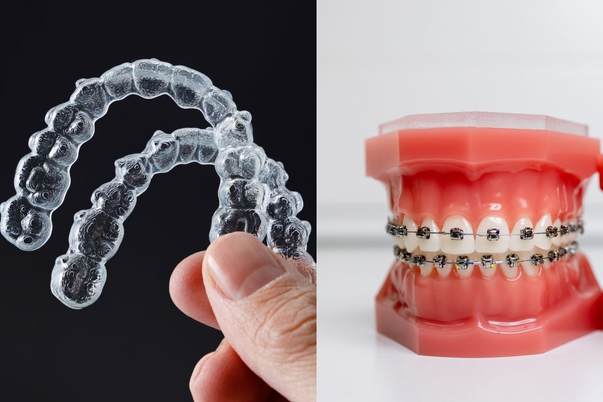 Aligners or Braces: Which One to Choose?