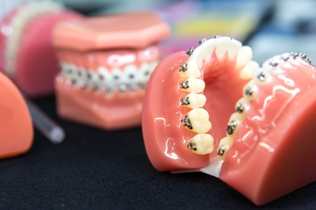 Orthodontics for Adults